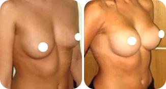 breast augmentation patient before and after result-5