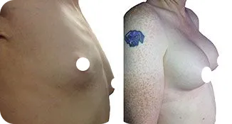 breast augmentation patient before and after result-6