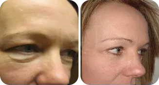 blepharoplasty patient before and after result-1