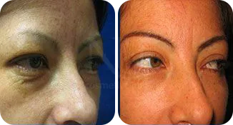 blepharoplasty patient before and after result-2