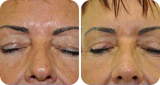blepharoplasty patient before and after result-3