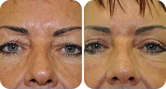 blepharoplasty patient before and after result-4