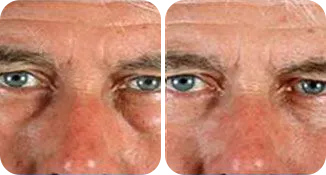 blepharoplasty patient before and after result