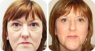 blepharoplasty patient before and after result