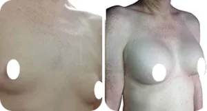 breast augmentation patient before and after result-7