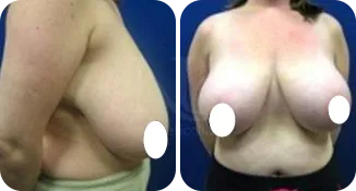 breast reduction surgery patient before and after result-5-v1