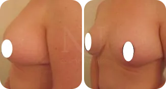 breast reduction surgery patient before and after result-6-v1
