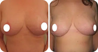 breast reduction surgery patient before and after result-6-v2
