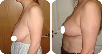 breast reduction surgery patient before and after result-7-v1