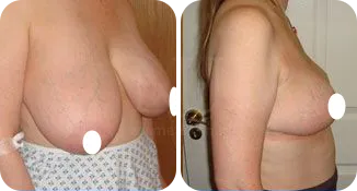 breast reduction surgery patient before and after result-7-v2