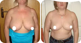 breast reduction surgery patient before and after result-8-v1