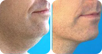 chin vaser liposuction before and after result