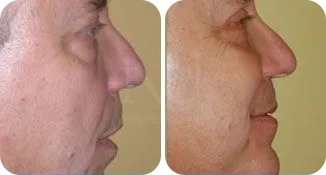 facelift patient before and after result