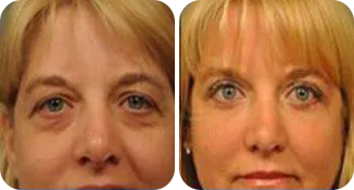 facial implant patient before and after result-1