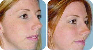 facial implant patient before and after result-2