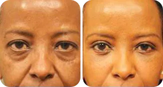facial implant patient before and after result
