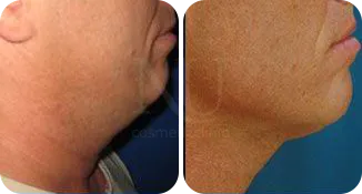 facial liposuction patient before and after result