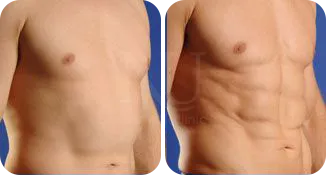 liposuction male patient before and after result