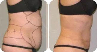 liposuction patient before and after result-2