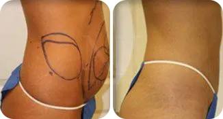 liposuction patient before and after result