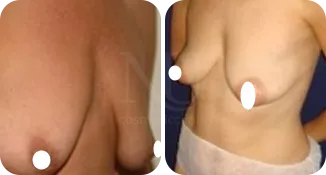 mastopexy breast augmentation patient before and after result-2