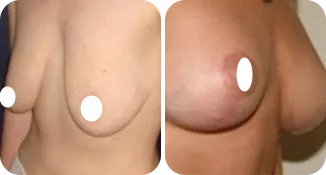 mastopexy breast augmentation patient before and after result-3