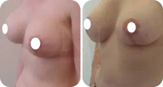 mastopexy breast augmentation patient before and after result-4