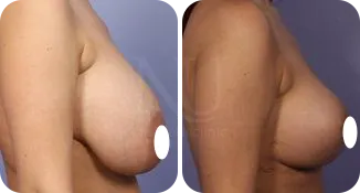 mastopexy breast augmentation patient before and after result-5