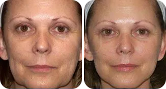 mini facelift patient before and after result