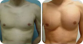 pectoral implant patient before and after result