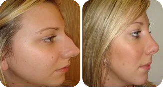 rhinoplasty patient before and after result-10