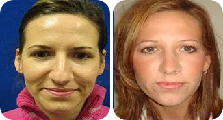rhinoplasty patient before and after result-11