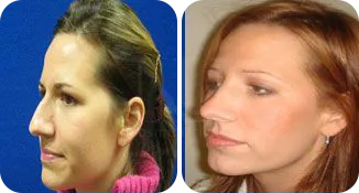rhinoplasty patient before and after result-12