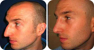 rhinoplasty patient before and after result
