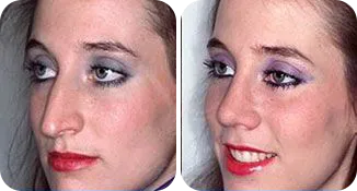 rhinoplasty patient before and after result-2