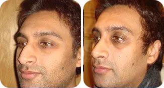 rhinoplasty patient before and after result-3