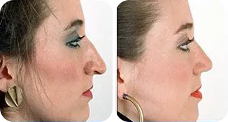 rhinoplasty patient before and after result-4