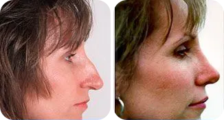 rhinoplasty patient before and after result-5