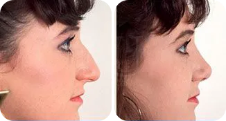 rhinoplasty patient before and after result-7