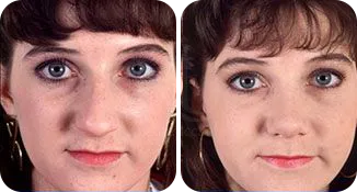 rhinoplasty patient before and after result-8