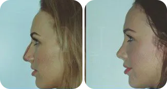 rhinoplasty patient before and after result