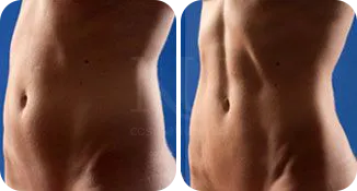 stomach vaser lipo patient before and after result-6