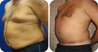 tummy tuck male patient before and after result-1