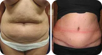 tummy tuck patient before and after result-1