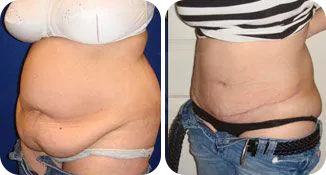 tummy tuck patient before and after result-2
