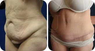 tummy tuck patient before and after result-3