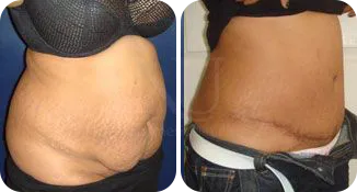tummy tuck patient before and after result-4