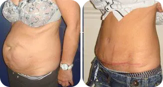 tummy tuck patient before and after result-5