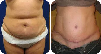 tummy tuck patient before and after result