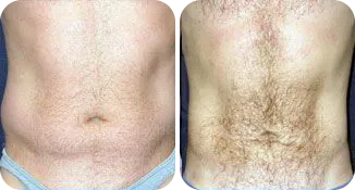 vaser lipo male before and after result-1